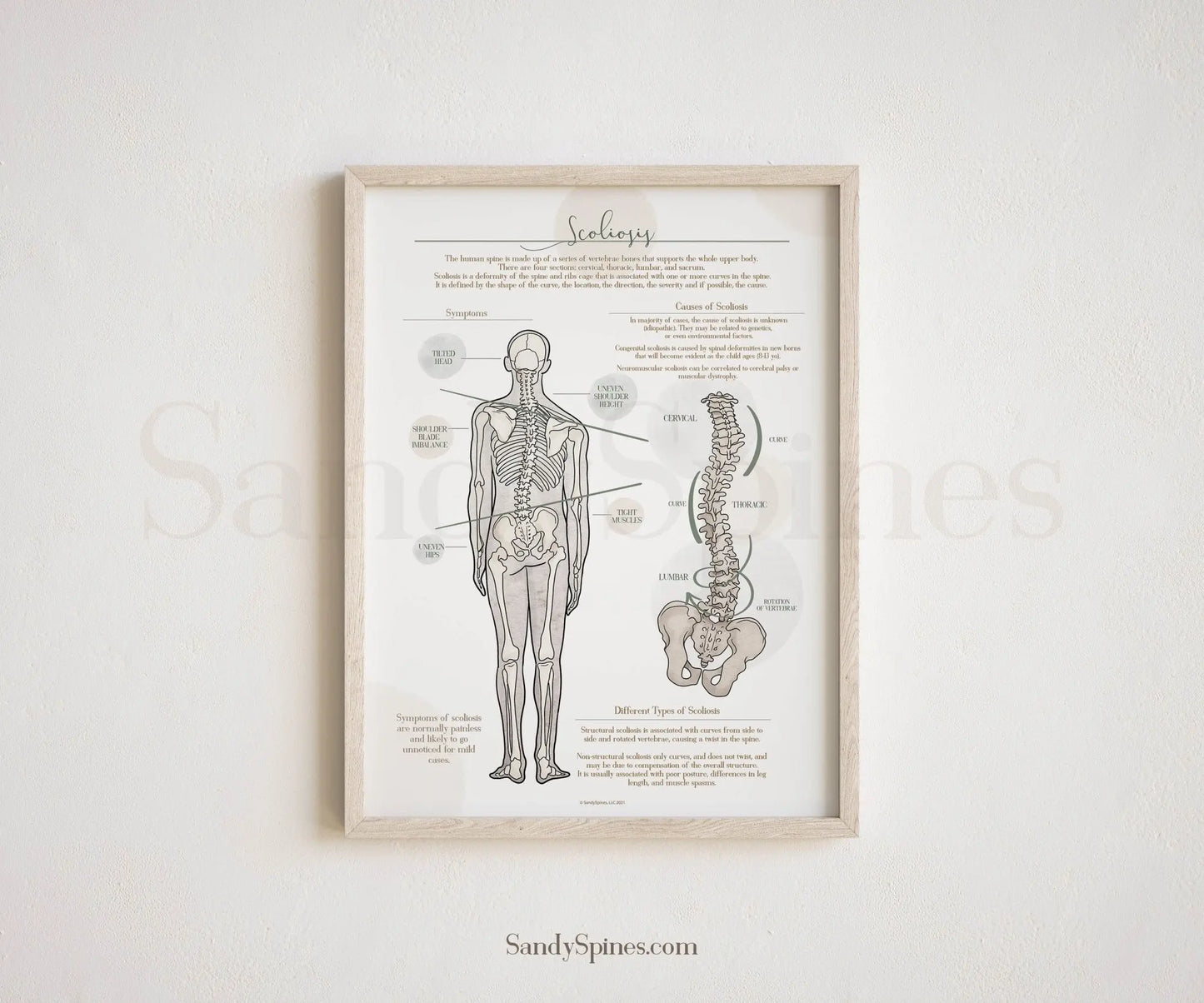 Scoliosis Anatomy Poster - SandySpines