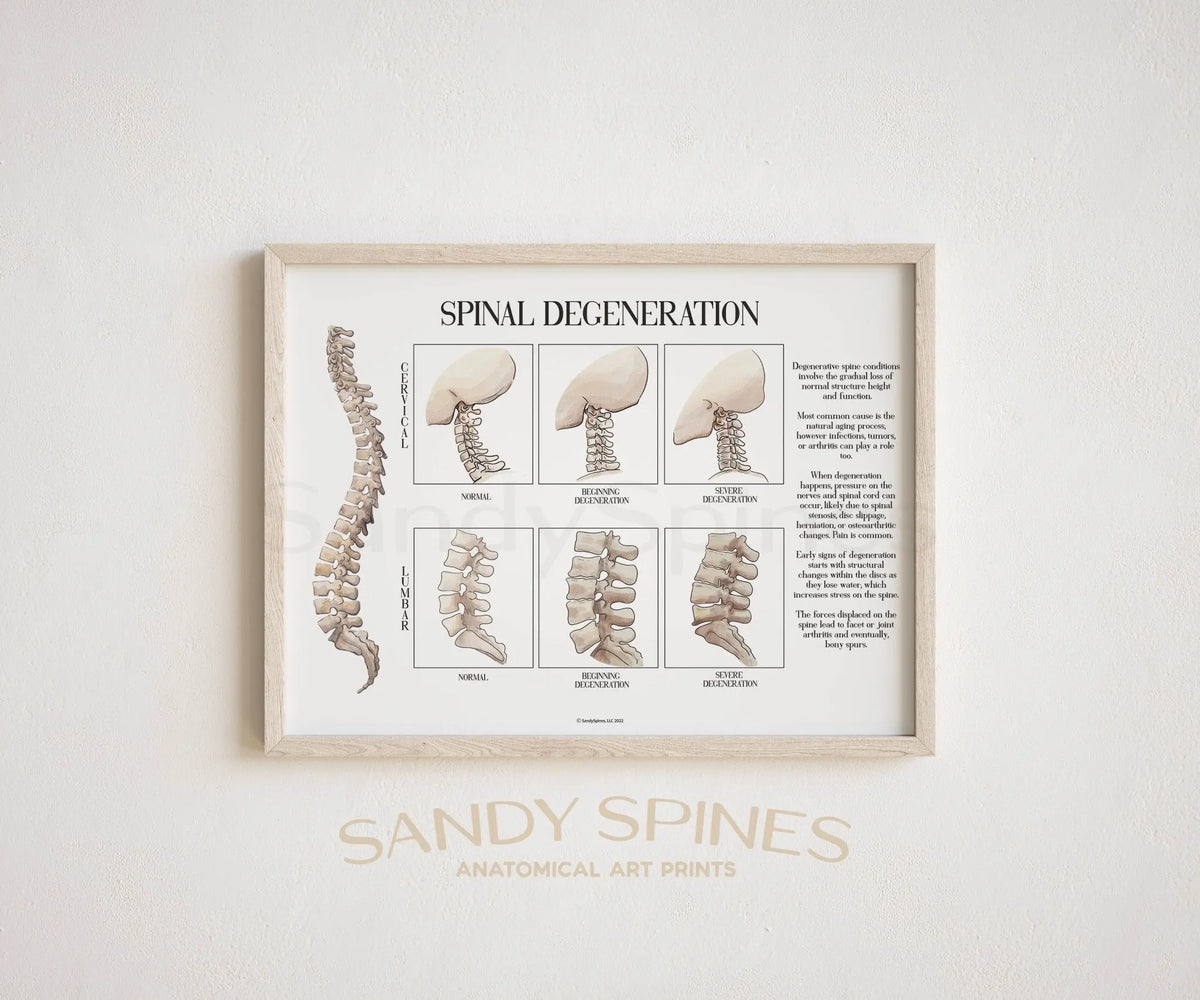 Spinal Degeneration Poster - SandySpines