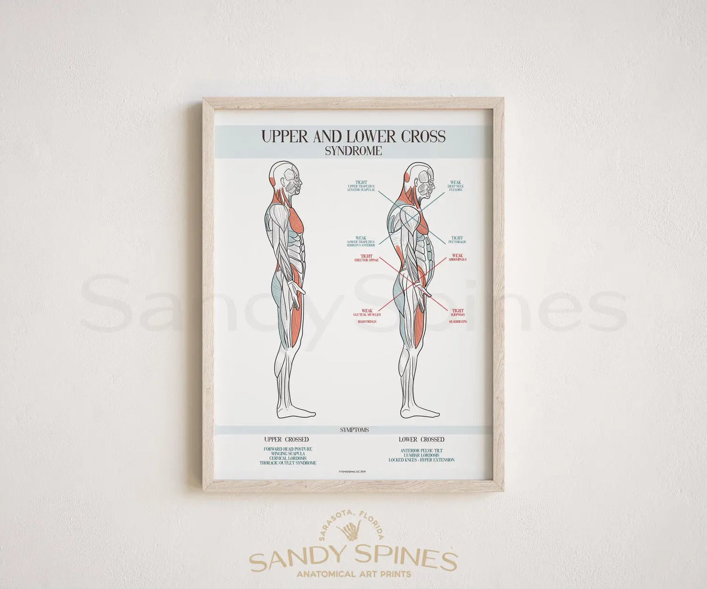Upper and Lower Cross Syndrome Poster SandySpines