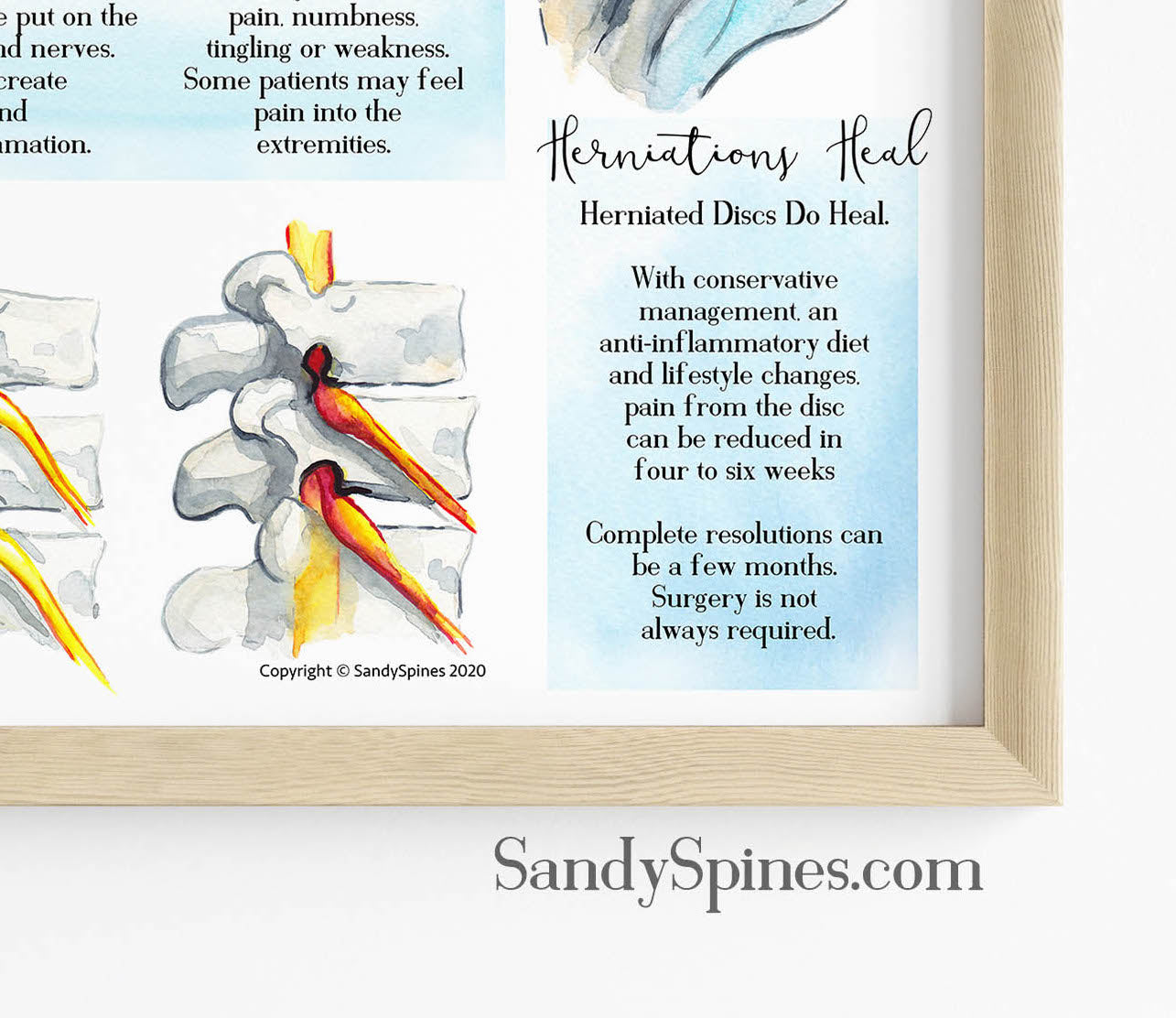 Anatomy of a Disc Herniation Poster