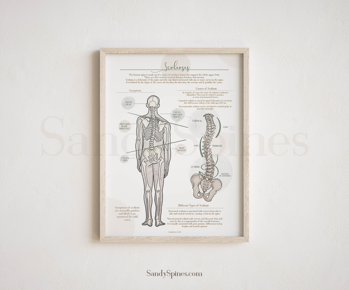 Scoliosis Anatomy Poster