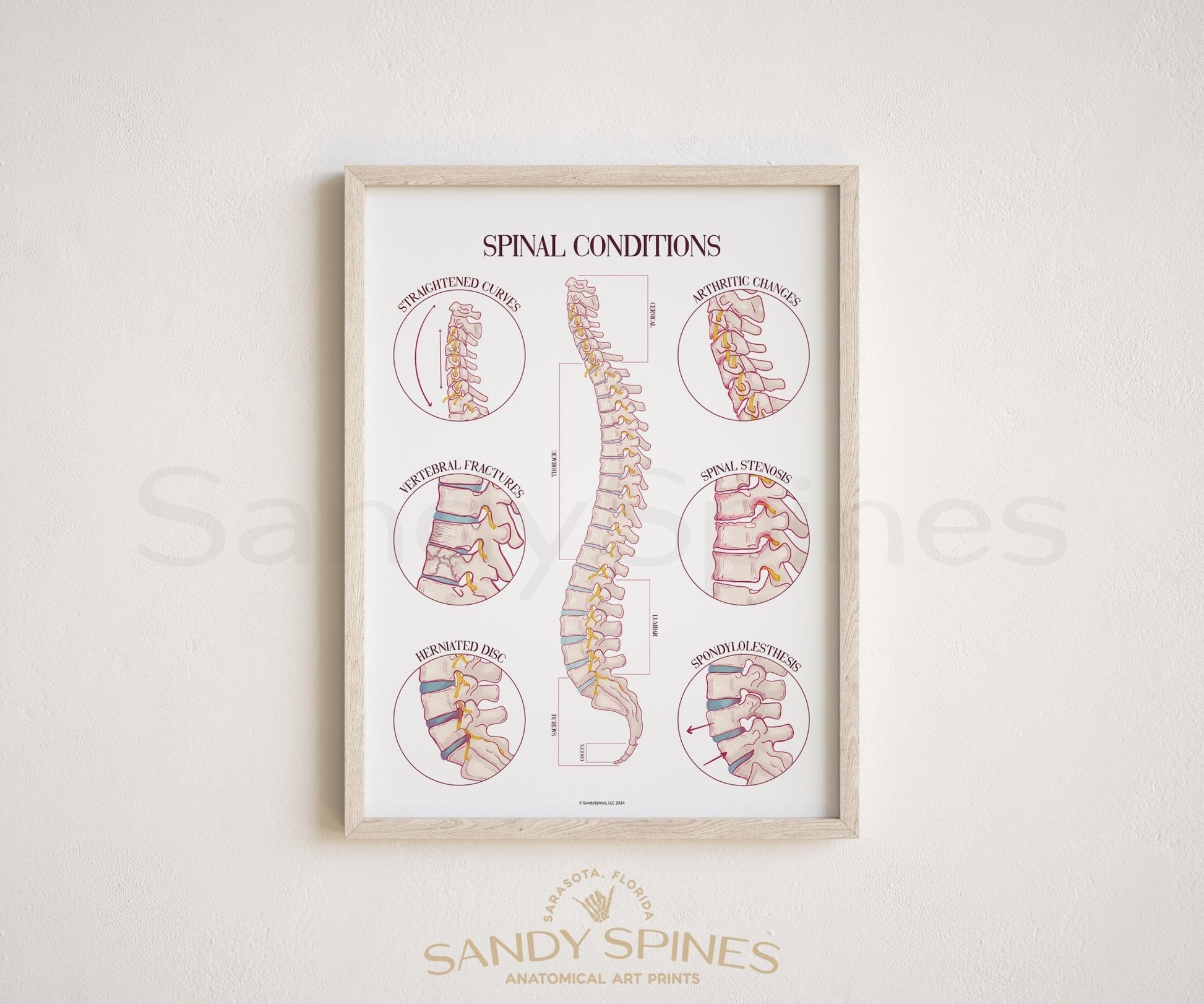 Spine Conditions Poster by SandySpines