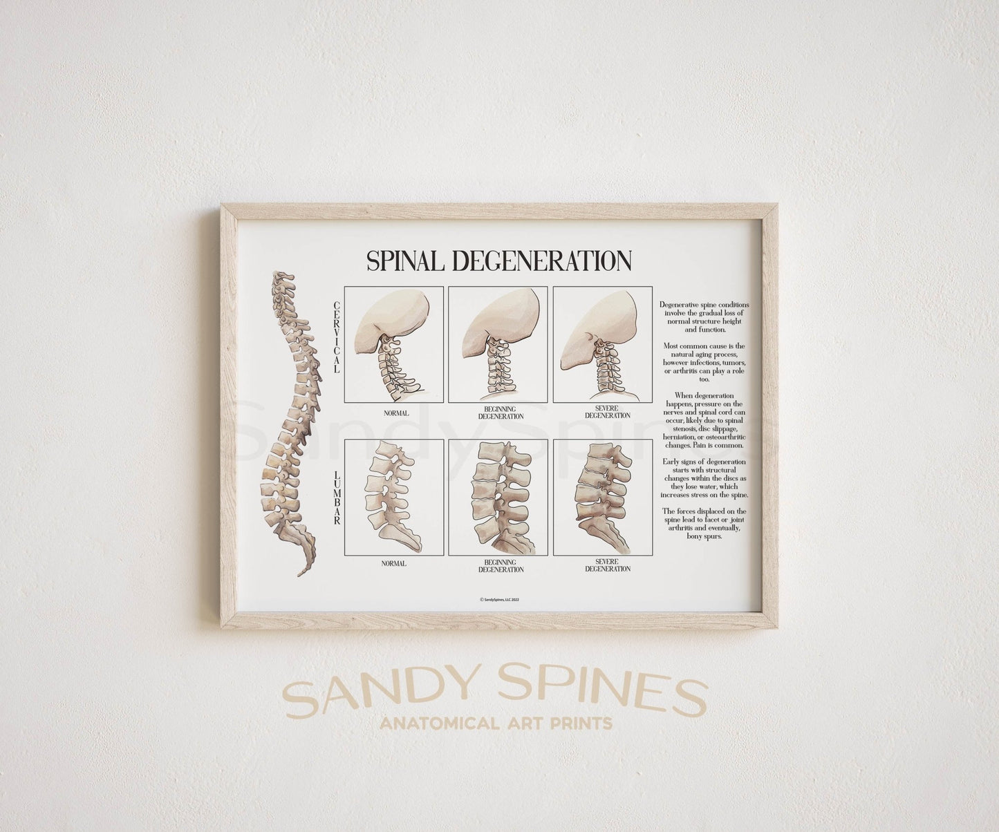 Spinal Degeneration Poster - SandySpines