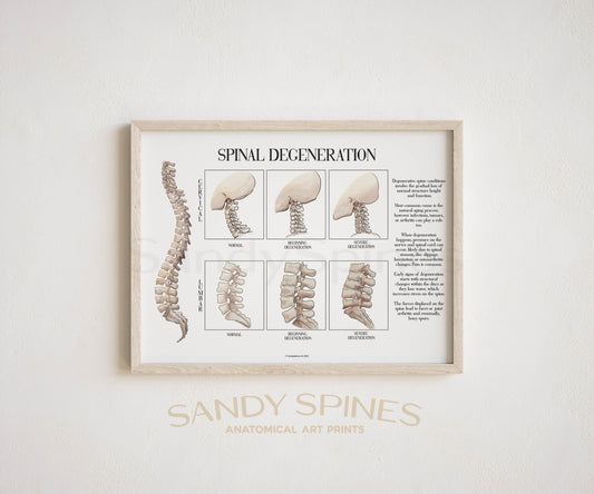 Spinal Degeneration Poster - SandySpines