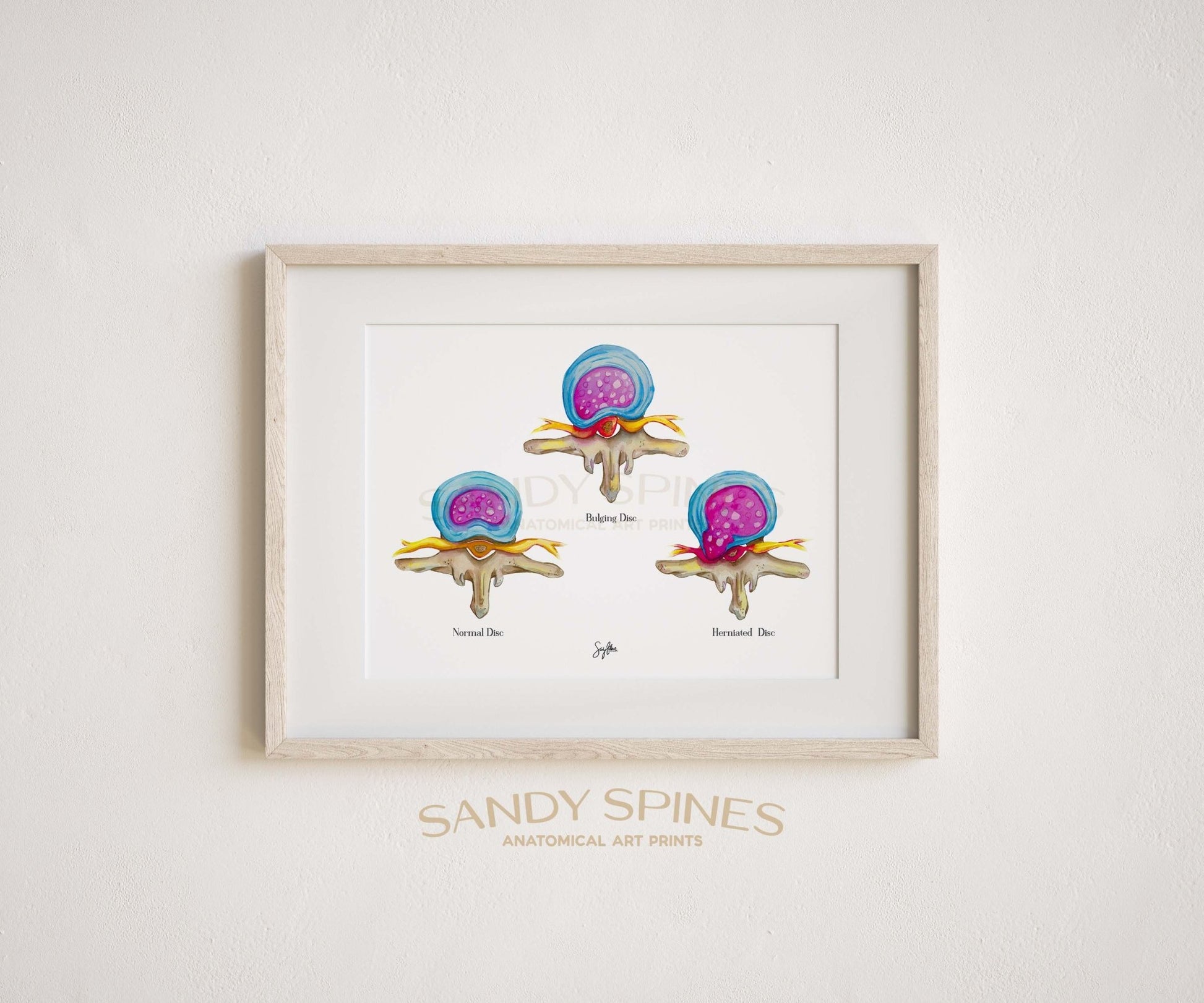 Spinal Disc Anatomy Watercolor Print (All in One) - SandySpines