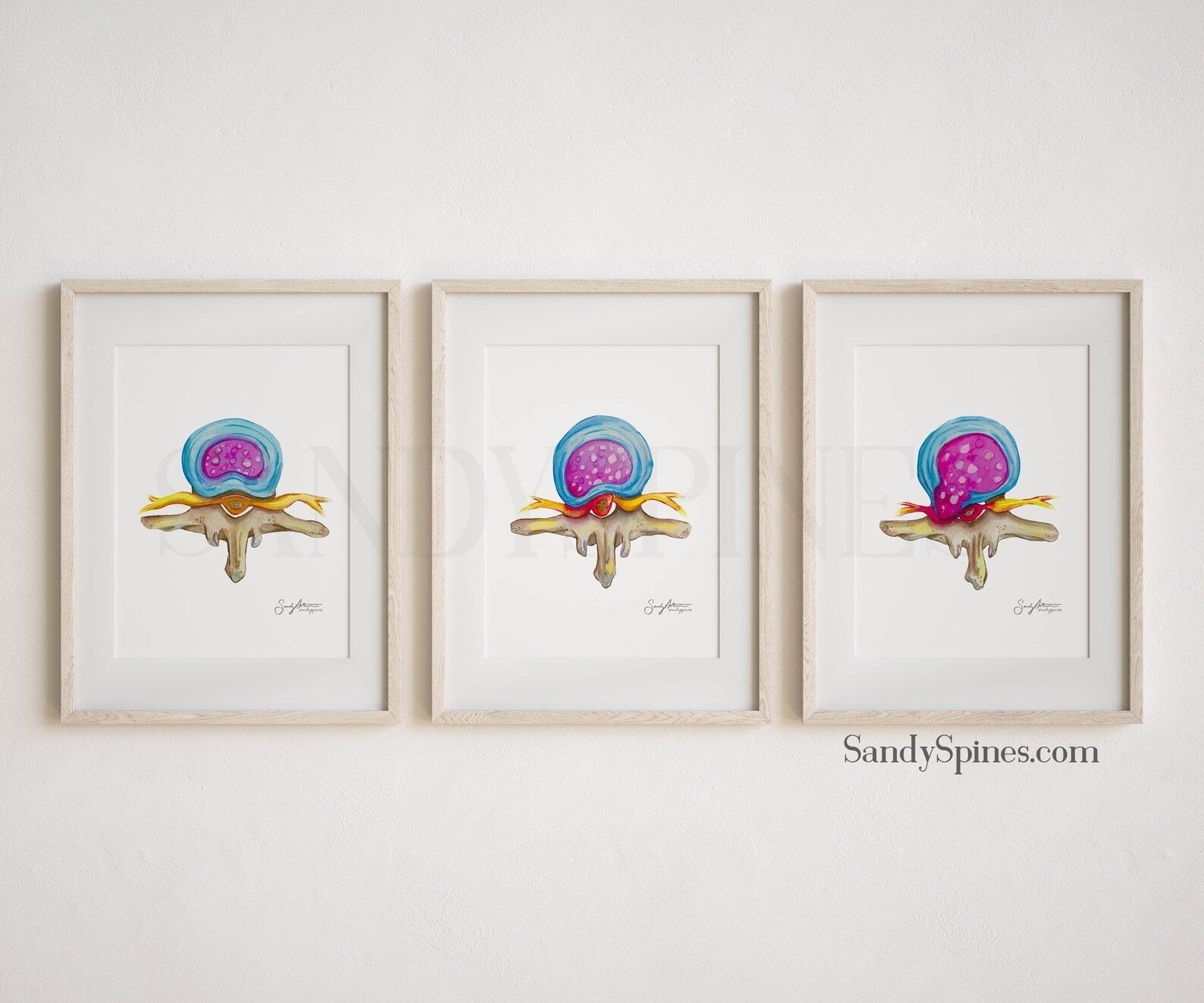 Spinal Disc Anatomy Watercolor Prints (Three) - SandySpines
