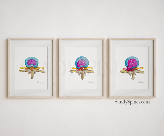 Spinal Disc Anatomy Watercolor Prints (Three) - SandySpines