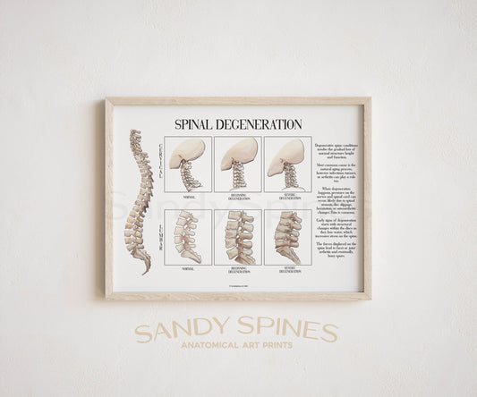 Spinal Degeneration Poster