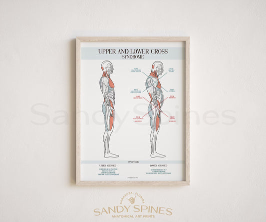 Upper and Lower Cross Syndrome Poster