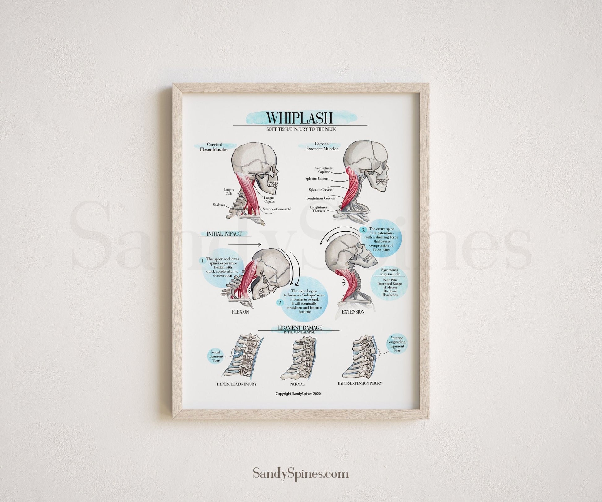 WHIPLASH Educational Poster - SandySpines